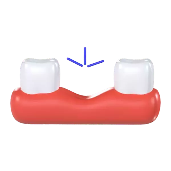 Missing Tooth 3d model--b9c4ad72-77d7-46bf-9bbf-8c545185a329