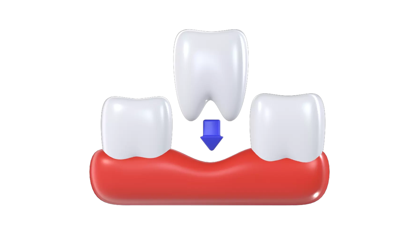 Tooth Filling 3D Graphic