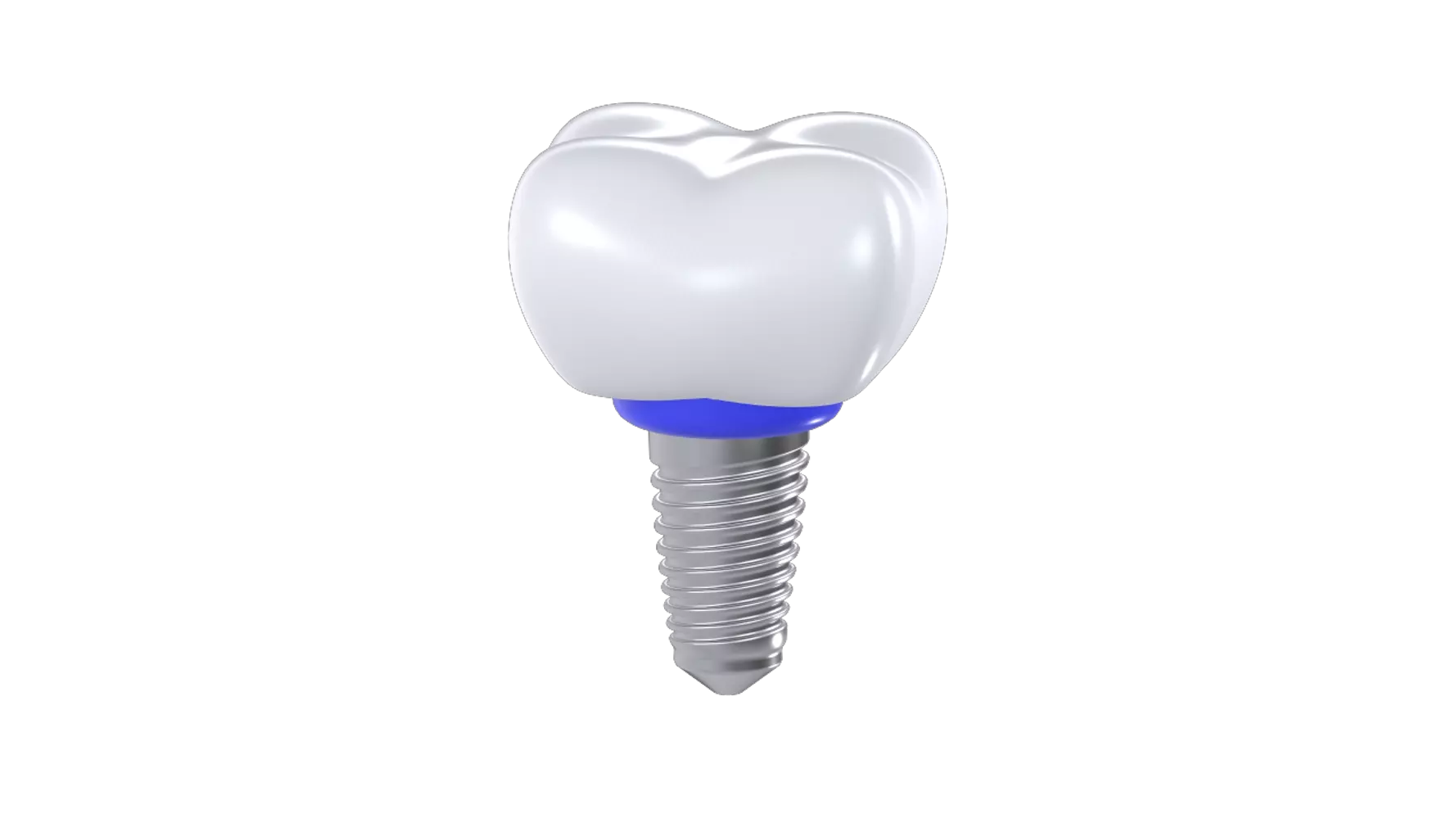 Dental Implant 3d model--a90584b7-8279-465f-87e7-97d67e742b9f