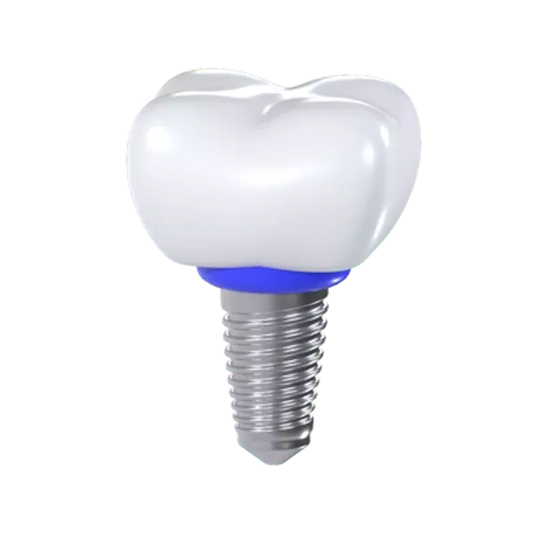 Dental Implant 3D Graphic