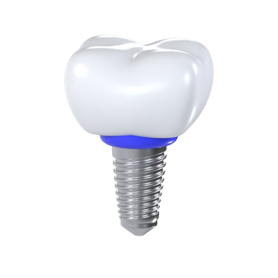 Dental Implant 3D Graphic