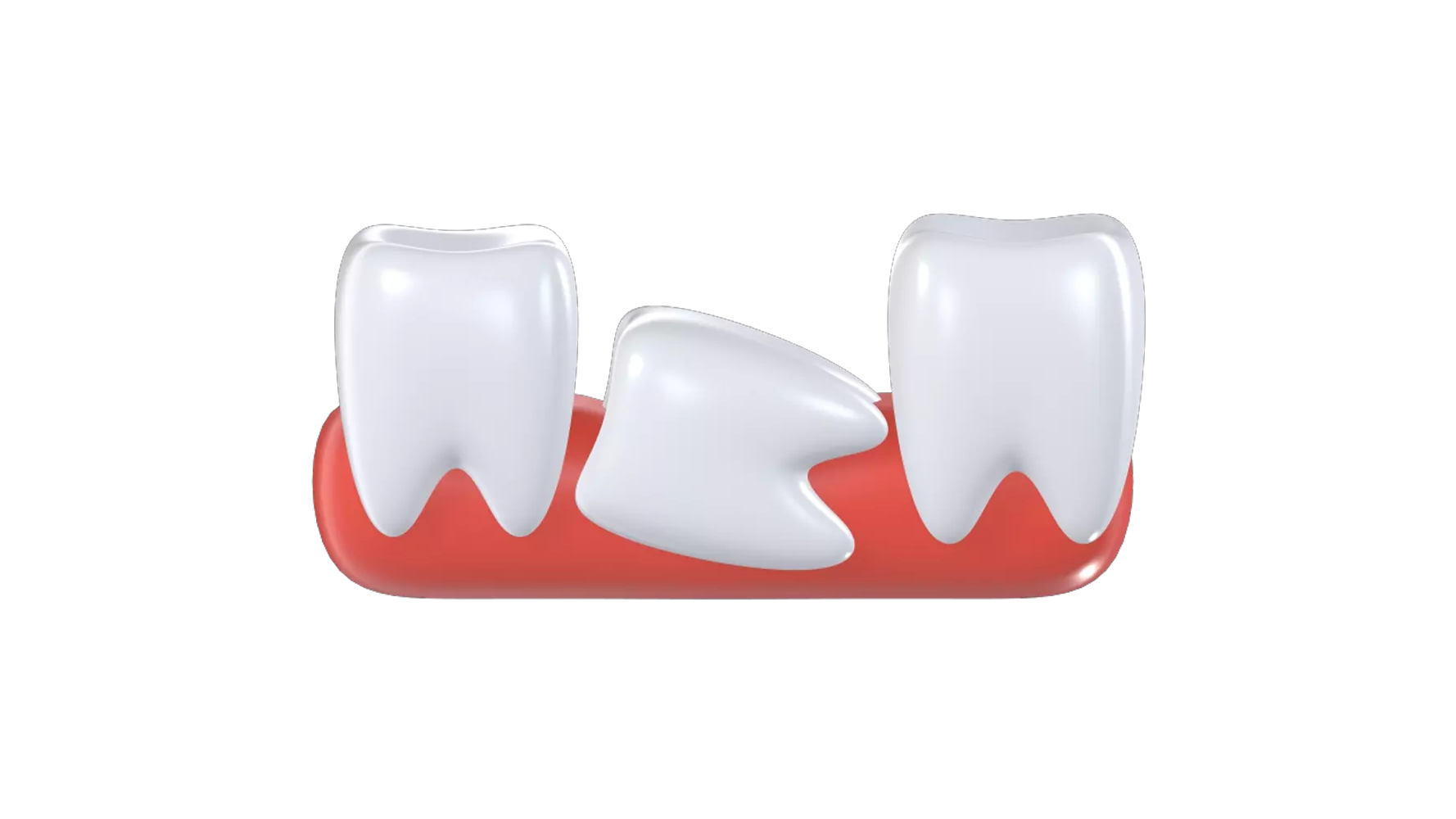 Impacted Tooth 3D Graphic