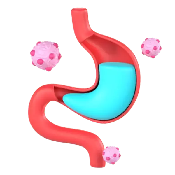 Stomach Cancer 3D Graphic